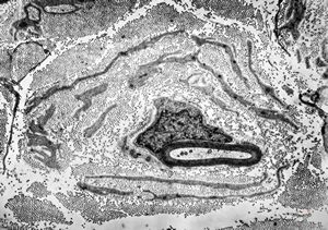 F,31y. | hypertrophic demyelinating neuropathy - n.suralis F,31y. | hypertrophic demyelinating neuropathy - n.suralis
